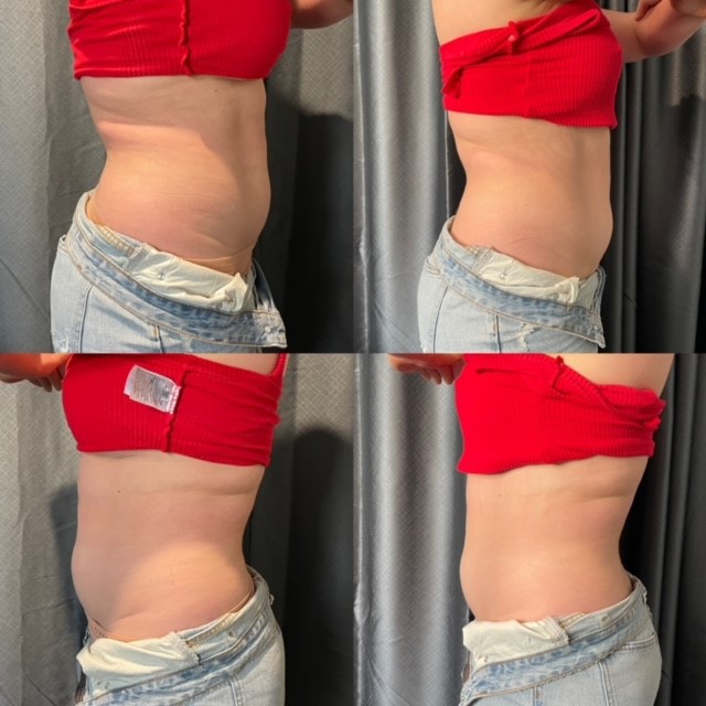 lipo stomach results brisbane