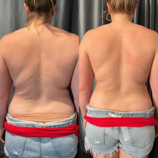 non invasive laser lipo results brisbane