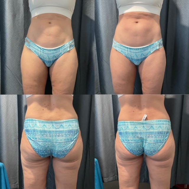 non invasive laser lipolysis laser brisbane